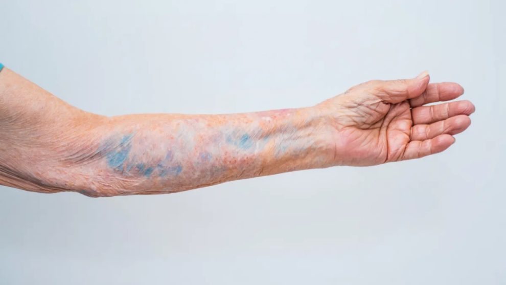 Mottled or Patchy Skin